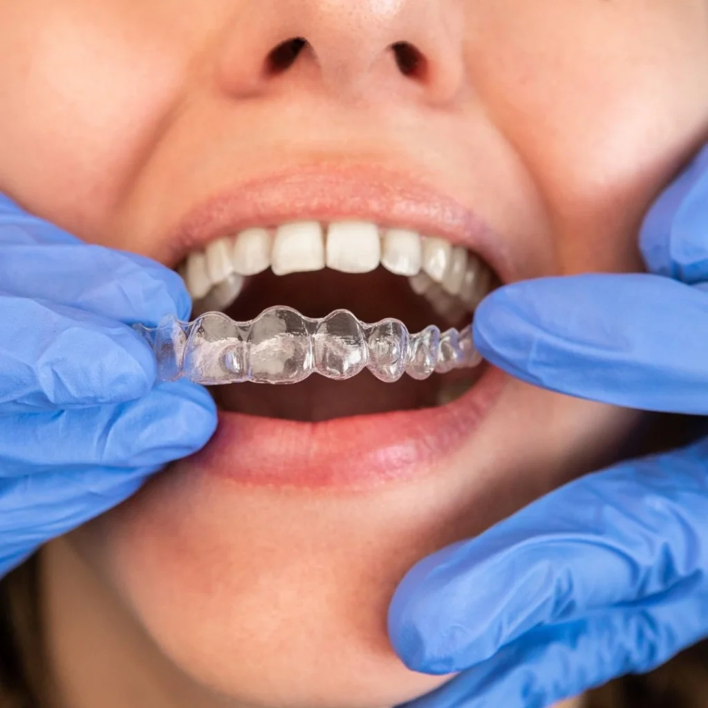 Clear aligners treatment in Auckland at Sandringham Dental