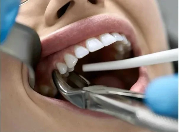 Dental extraction treatment in Auckland at Sandringham Dental