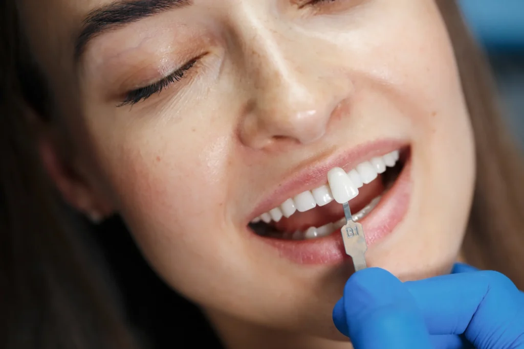 Dental crowns and veneers treatment in Auckland at Sandringham Dental