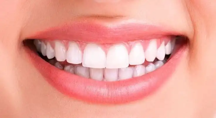 teeth-whitening-after.webp