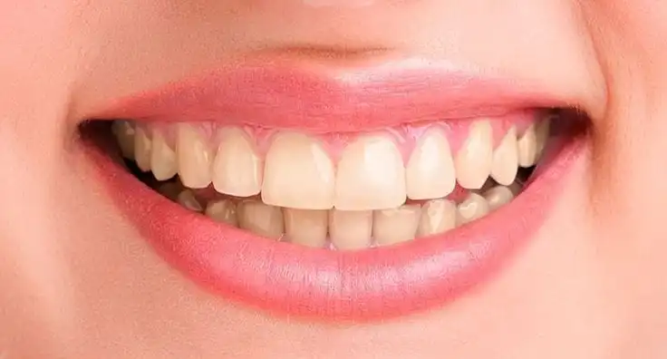 teeth-whitening-before.webp