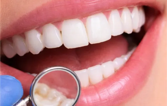 After Dental Cleaning