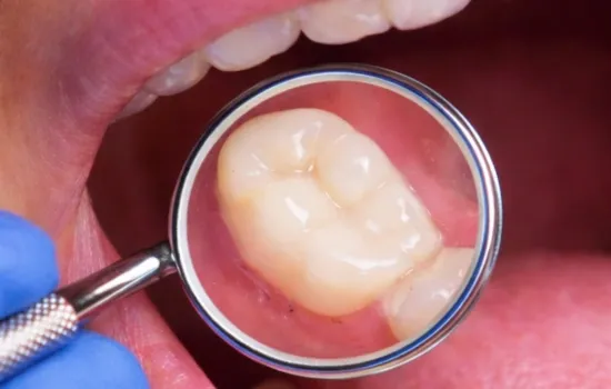 After a Root Canal Treatment