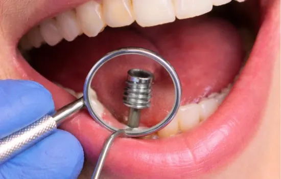After-implant-dentistry