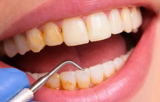 Before Dental Cleaning