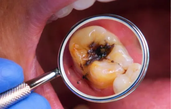 Before a Root Canal Treatment