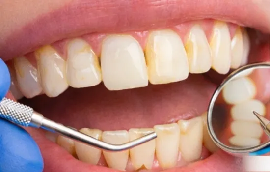 Before a dental checkup