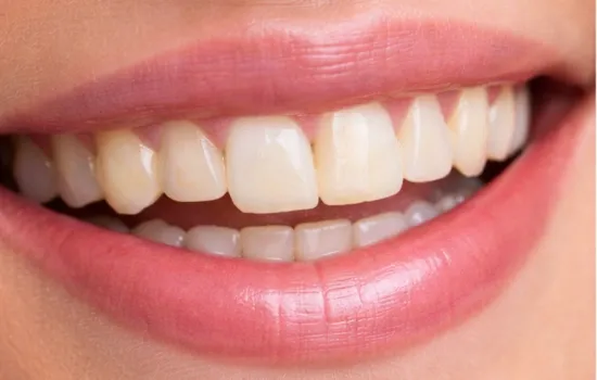 Before cosmetic dentistry