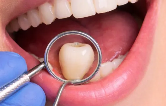 Before-implant-dentistry