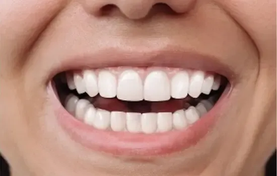 Clear Aligners after-service