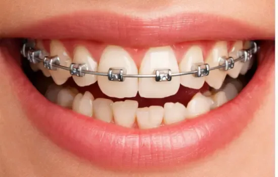 Orthodontic Treatment Before Service