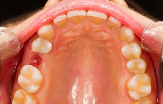 Tooth Extraction After-service