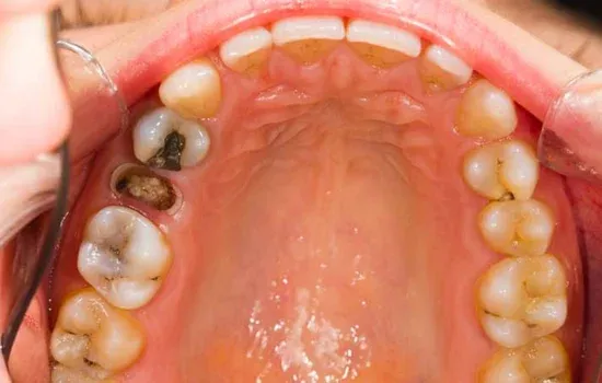 Tooth Extraction Before Service