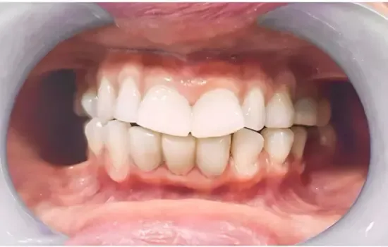 after-dental-filling