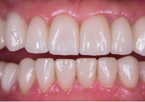 after-denture