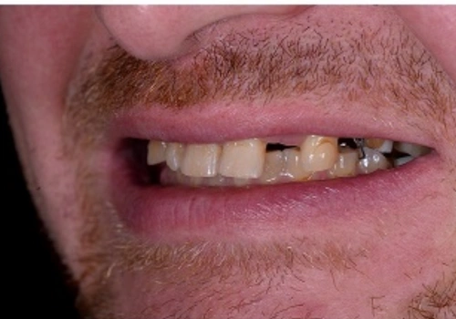 before-dental-crown