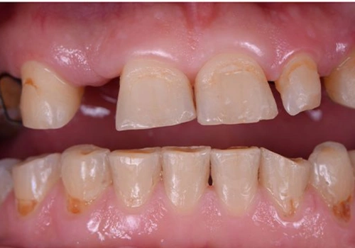 before-denture (1)