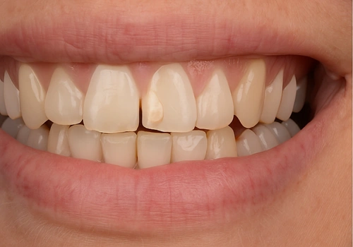 before-porcelain-veneer