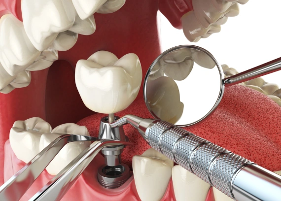 Dry Socket After Tooth Extraction: Causes, Symptoms and Treatment Guide
