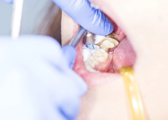 Tooth Extraction Infection: Signs, Causes, Treatment and Prevention Guide