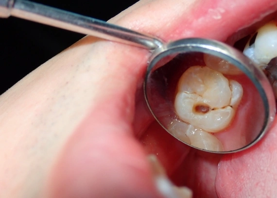 How to Prevent Tooth Cavity: Simple Tips for Healthy Teeth