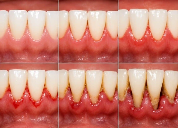 Early Signs of Gum Disease You Shouldn’t Ignore