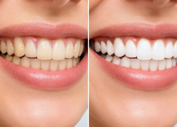 Teeth Whitening: Professional vs At-Home Kits Explained
